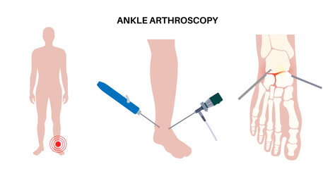 Poster - Ankle arthroscopy poster