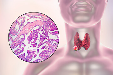 Poster - A 3D scientific illustration showcasing a human body with transparent skin, revealing a tumor in his thyroid gland, along with a micrograph image of thyroid cancer.