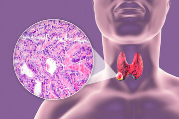 Sticker - A 3D scientific illustration showcasing a human body with transparent skin, revealing a tumor in his thyroid gland, along with a micrograph image of thyroid cancer.