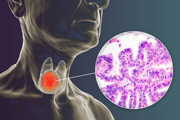 Sticker - A 3D scientific illustration showcasing a human body with transparent skin, revealing a tumor in his thyroid gland, along with a micrograph image of thyroid cancer.