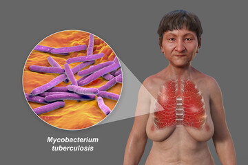 Sticker - A 3D illustration of a woman with transparent skin, showcasing the lungs affected by miliary tuberculosis and close-up view of Mycobacterium tuberculosis bacteria