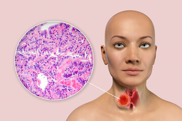 Poster - A 3D scientific illustration showcasing a woman with transparent skin, revealing a tumor in her thyroid gland, along with a micrograph image of thyroid cancer.