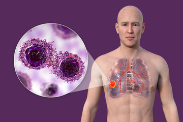 Canvas Print - A 3D illustration of the upper half part of a man with transparent skin, revealing the presence of lung cancer