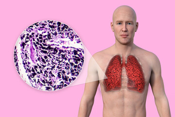 Canvas Print - A 3D illustration of the upper half part of a man with transparent skin, revealing the condition of smoker's lungs