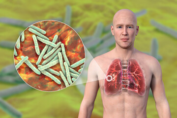 Sticker - A 3D illustration of the upper half of a man with transparent skin, showcasing the lungs affected by cavernous tuberculosis, and close-up view of Mycobacterium tuberculosis bacteria