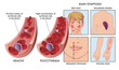 Medical illustration compares an artery with a normal number of red blood cells, with one affected by polycythemia, with drawings to the right showing symptoms, completed with annotations.