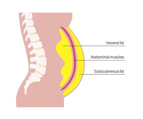 Canvas Print - Visceral fat diagram