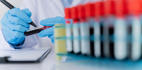 Doctor's hand holding a blood sample vial, blood test medical device, holding a vial of blood sample in front of a blood test model.