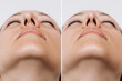 A close-up of woman's nose before and after rhinoplasty on gray background. The result of cosmetic plastic surgery on the nose. Bottom view. Correction of the nasal septum. Beauty concept