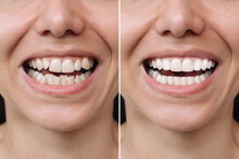 Cropped Shot Of A Young Caucasian Smiling Woman Before And After Veneers Installation. Teeth Whitening. Dentistry, Dental Treatment. Сorrection Of Uneven Teeth With Braces