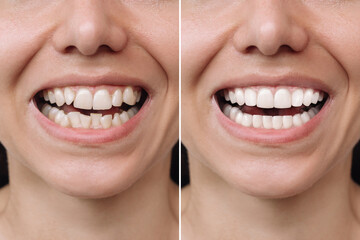 cropped shot of a young caucasian smiling woman before and after veneers installation. teeth whiteni