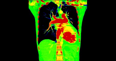 Wall Mural - CT Scan of chest  in colorful mode look like  Pet CT scan.	