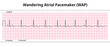 ECG Wandering Atrial Pacemaker (WAP) - 8 Second ECG Paper - Electrocardiography Vector Medical Illustration
