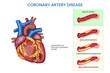 Coronary artery disease,  Narrowed arteries, reduced blood flow, increased risk of heart complications
