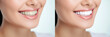 © dinastya - Collage female smile before and after teeth whitening. Advertising procedure whitening smile on white background. The concept of professional teeth whitening. Generative AI photo.