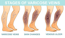 Human Legs With Health Problems. Varicose Veins. Stages Of Vein Disease. Medical Infographic. Vector Illustration. Healthcare Illustration. 