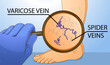 Human legs with health problems. Varicose veins. Diagnosis of varicose veins.  Vector illustration. Healthcare illustration.  