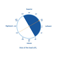 Wall Mural - The axis of lead aVL faces the upper left quadrant, along the origin as the perpendicular line, which can be divided into positive and negative sides.