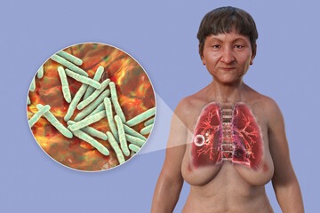 Wall Mural - A 3D illustration of the upper half of a female patient with transparent skin, showcasing the lungs affected by cavernous tuberculosis