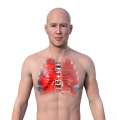 Canvas Print - A 3D illustration showcasing the upper half part of a man with transparent skin, revealing the lungs affected by pneumonia