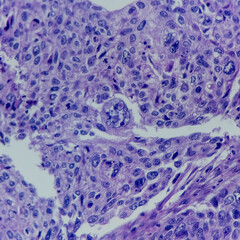 Poster - Camera photo of breast carcinoma, showing severe nuclear atypia in the center, magnification 400x, photograph through a microscope