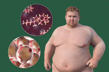 Poster - An overweight man with a close-up view of adipocytes and cholesterol molecules, 3D illustration