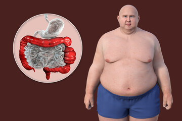 Poster - An overweight man with the presence of large intestine spasms associated with irritable bowel syndrome, 3D illustration