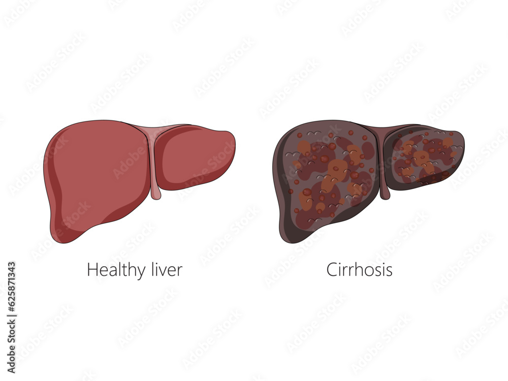 Healthy liver and liver with cirrhosis disease schematic vector ...