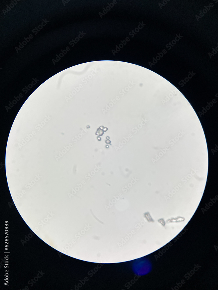 View of Microscopic view of struvite crystals from urinary sediment. Magnesium ...