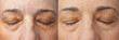 Xanthelasma on all 4 eyelids of a 55 years old woman, before and after applying camouflage make-up on lower and eye shadow on the spots of upper lids.