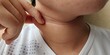 © Rung Kh - close up the fingers holding the flabbiness adipose sagging skin under the neck, wattle and cellulite under the chin of the woman, health care and beauty concept.