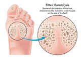 Fototapeta  - Medical illustration of symptoms of pitted keratolysis, a bacterial skin infection of the foot.