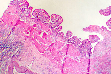 Sticker - Photomicrograph of chronic cholecystitis