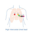Sometimes, it is necessary to place electrodes in the high intercostal space at the conventional chest lead electrode placement position, which is called a high intercostal chest lead.