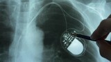 Fototapeta  - Doctor Examining X-Ray Image of Chest with Artificial Cardiac Pacemaker Implant