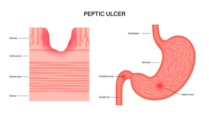 Canvas Print - Peptic ulcer disease