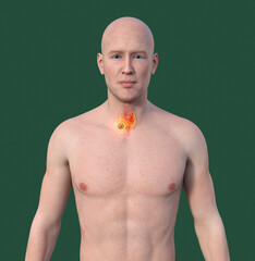 Poster - Thyroid cancer, 3D illustration