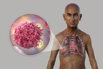 Sticker - A 3D illustration of a man with transparent skin, revealing the presence of lung cancer