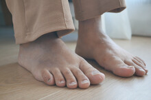 Close Up Of Women Feet With Swelling 