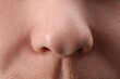 © New Africa - Young man with acne problem, closeup view of nose