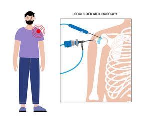 Poster - Shoulder arthroscopy poster