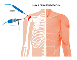 Poster - Shoulder arthroscopy poster