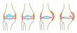 変形性膝関節症の進行度別イラスト