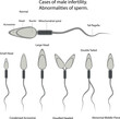 Vector illustration cases of male infertility. Abnormalities of sperm.