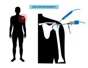 Poster - Shoulder arthroscopy poster