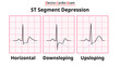 ECG Morphology of ST Segment Depression - Horizontal, Upsloping, and Downsloping - Medical Electrocardiogram Vector Illustration