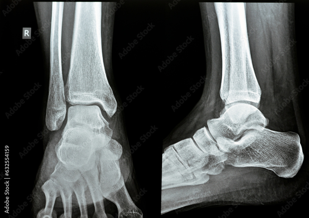 Gallery Detail: Plain X Ray Ap Lateral Views Of The Right Ankle