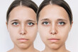 © Марина Демешко - Young attractive caucasian woman's face with drooping upper eyelid before and after blepharoplasty isolated on a white background. The result of plastic surgery. Changing the shape, cut of the eyes