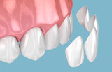 Fototapeta Kosmos - Dental veneer placement over frontal teeth. 3D illustration