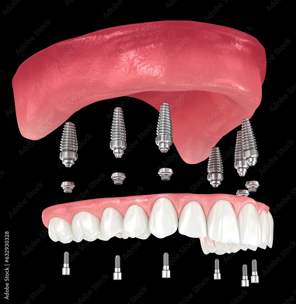 Maxillary Prosthesis Maxillary prosthesis based on 6 implants. Dental 3D illustration Stock ...